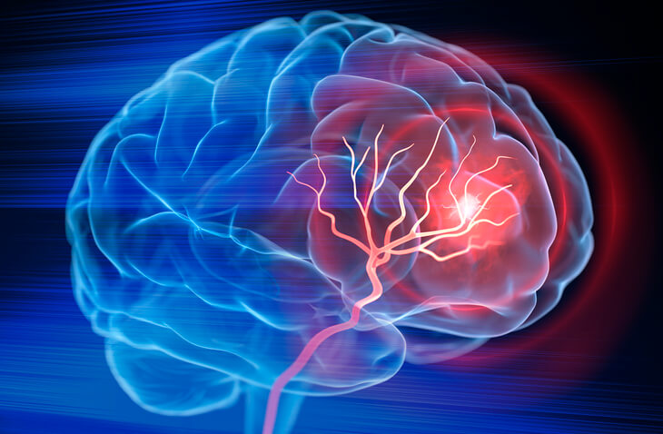 brain scan showing stroke